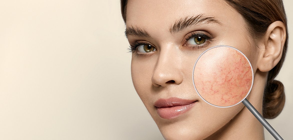 Lupe zeigt Rosacea auf der Haut einer jungen Frau.